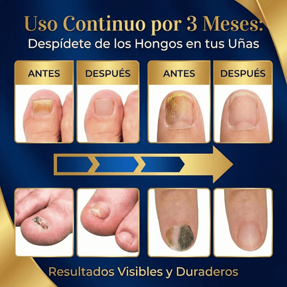 Los hongos NO desaparecen tapándolos. Usa esta lampara directo sobre la uña y empieza a notar el cambio.